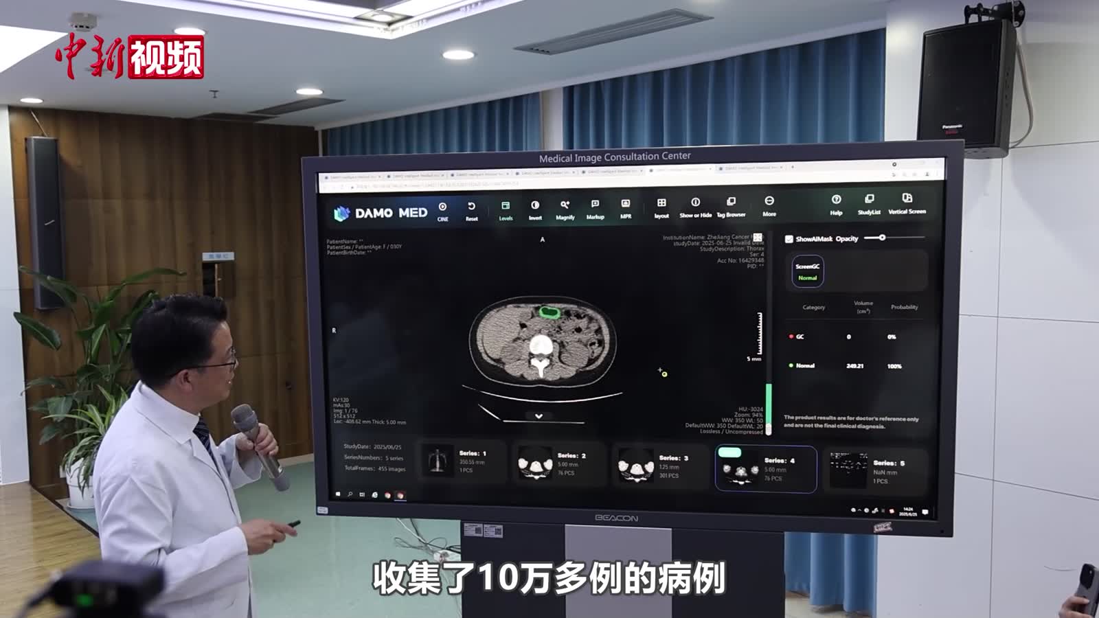 全球首個(gè)胃癌影像篩查AI模型發(fā)布