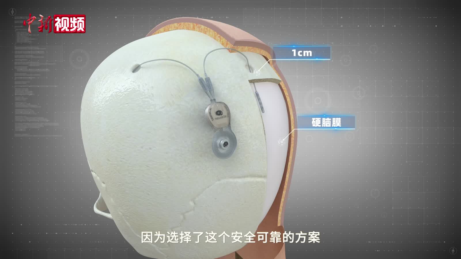 清华团队：将有更多患者使用中国设计制造的脑机接口产品