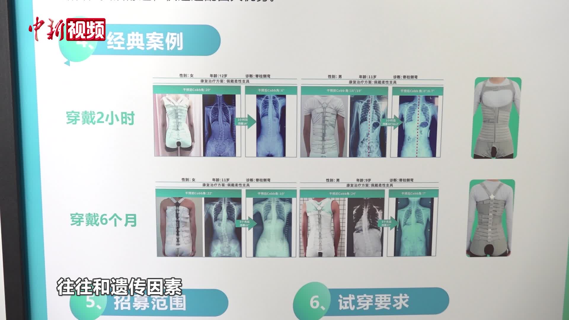医生：脊柱侧弯隐蔽性强、易被忽视 很多家长发现晚了